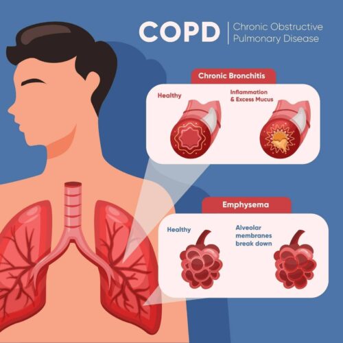 November: COPD Awareness Month