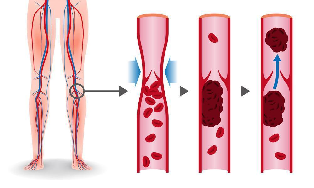 Deep Vein Thrombosis Awareness